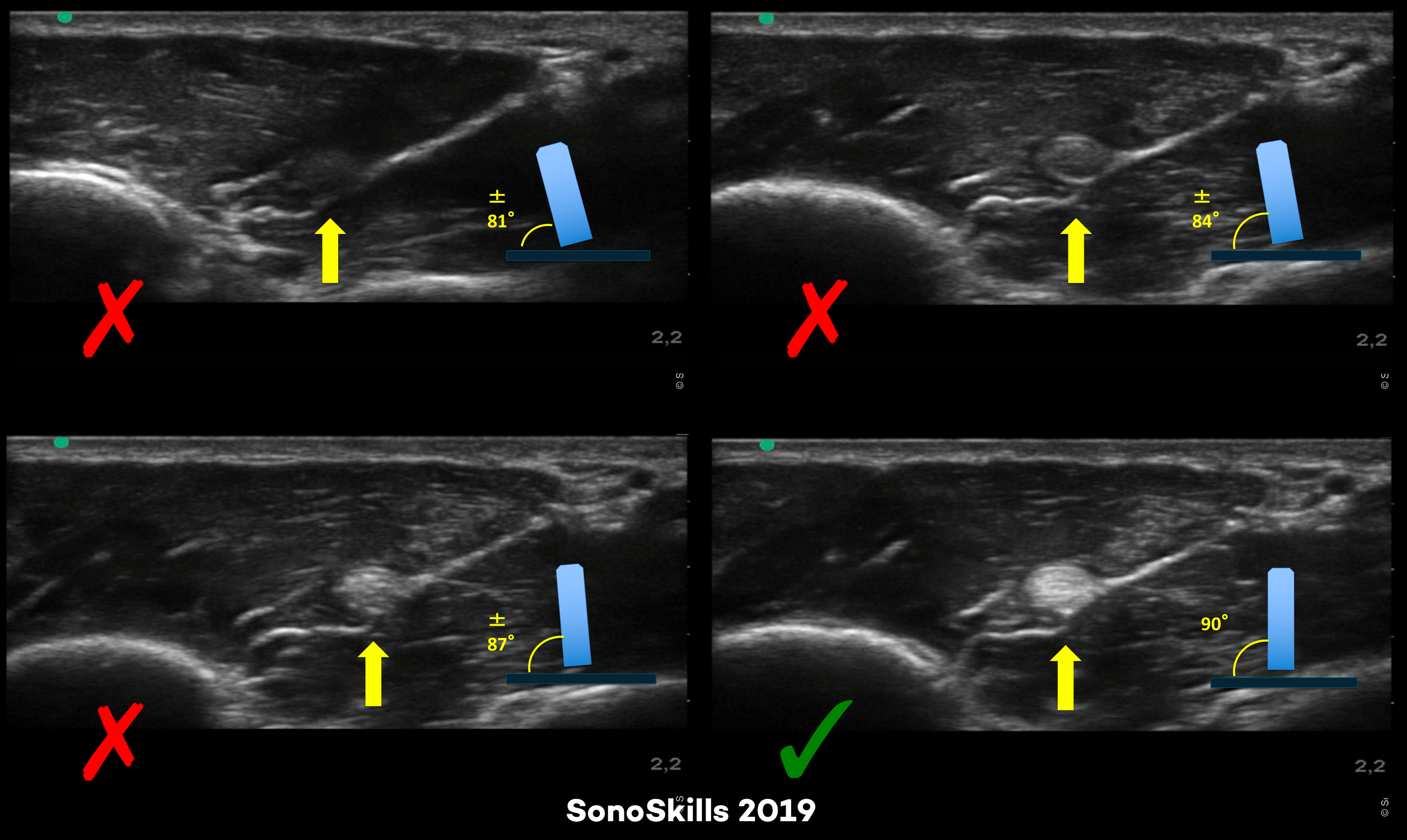 Анизотропия в УЗИ это. Сонография ТБН углы. Метро сонография. 123 Sonography lung Sonography.