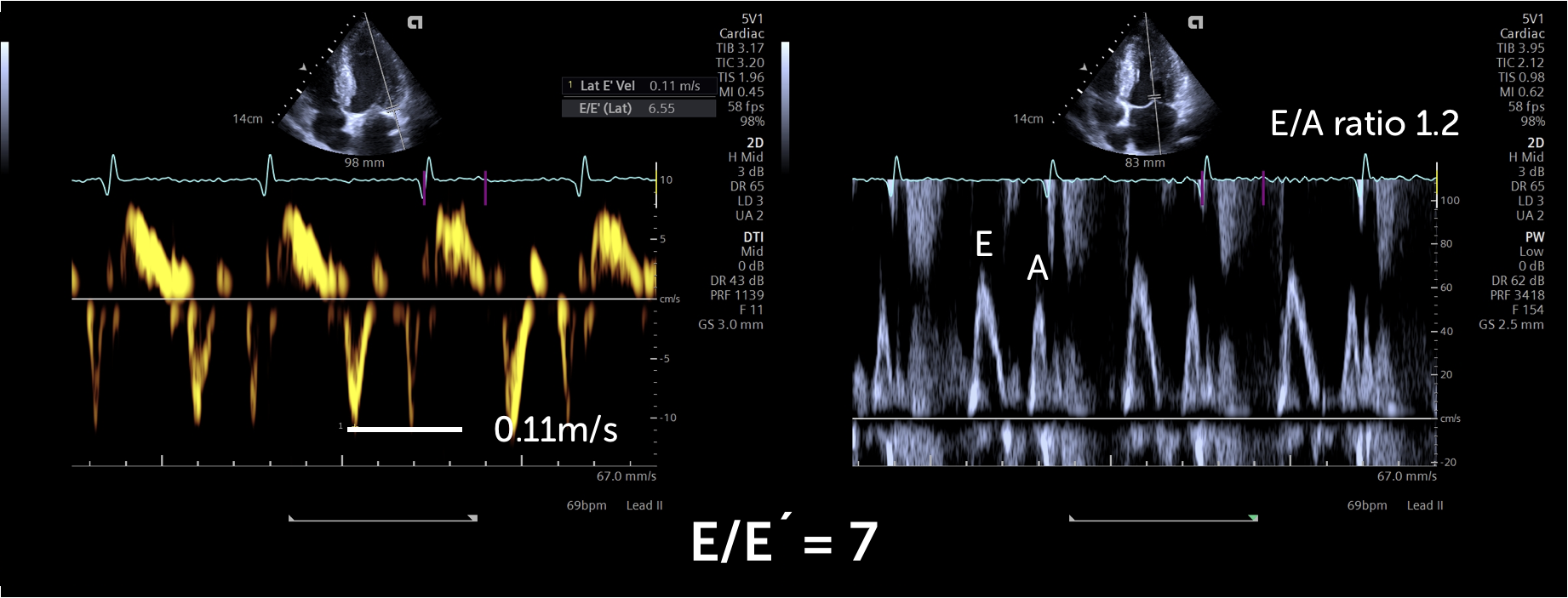 Common Mistakes Diastolic Dysfunction 123 Sonography