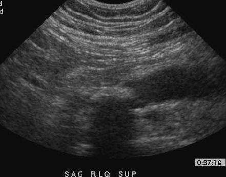 ruptured appendix ultrasound
