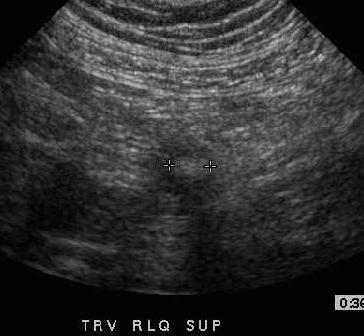 appendicolith ultrasound
