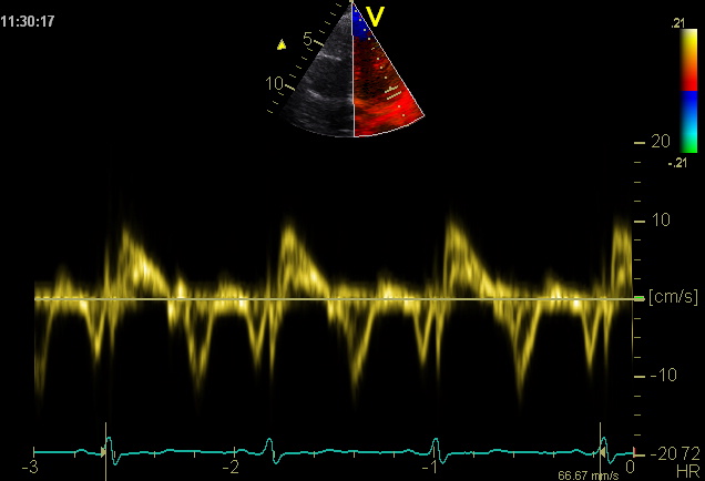 Standard left ventricular (LV) planes. a–d Short-axis (a), 4