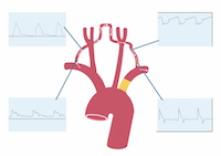 Subclavian steal syndrome.