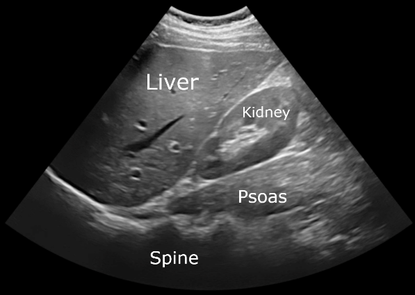 Ultrasound image, carotid artery.