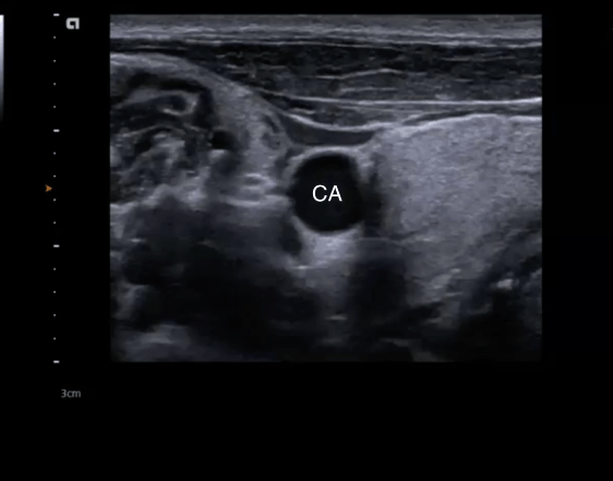 ultrasound image, carotid artery.