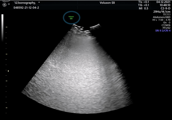 Ultrasound image of an abdomen.