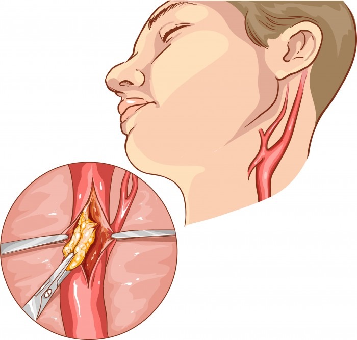 Carotid endarterectomy