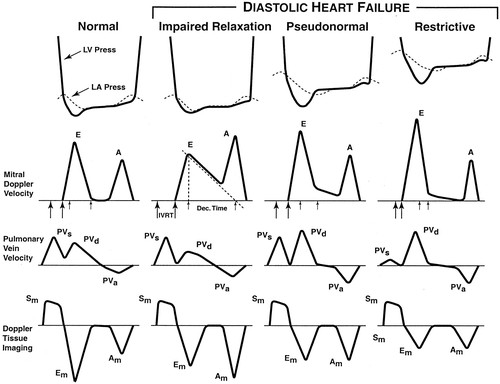 The Symptoms of Diastolic Dysfunction, Causes and Treatment