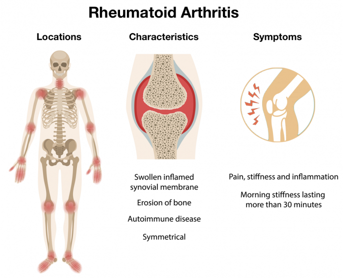 Arthritis Illust Arthritis Illust