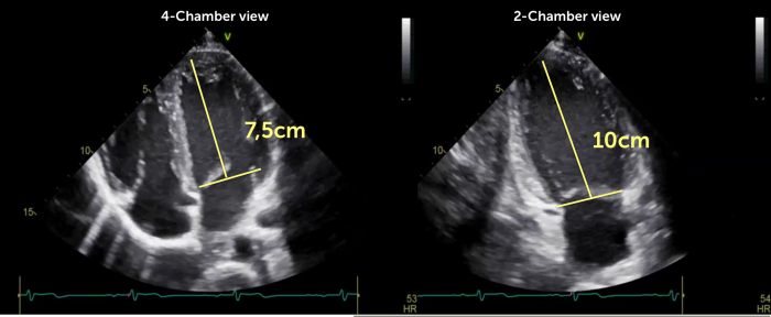 Case 43: Significant Spontaneous Echo Contrast In Left Ventricle (  DCM/Severe LV Dysfunction / LVEF : 15% in M- Mode / LVEF : 10% In Simpson's  Method., By Interesting cases in Echocardiography