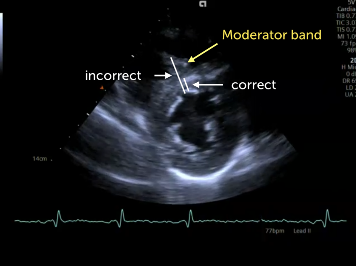 ECHO picture with hyperechoic moderator band in the right ventricle