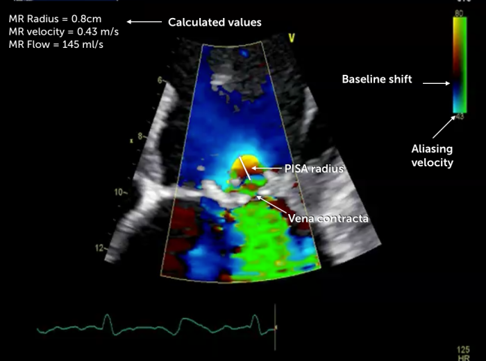 PISA Measurements 1 PISA Measurements echo sonography ultrasound