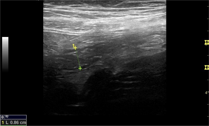 05_Appendicitis Image 05_Appendicitis Image