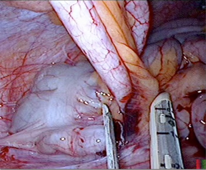 07_Appendicitis Imag 07_Appendicitis Imag