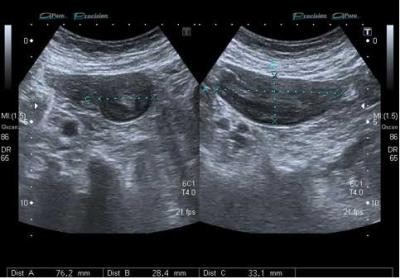 1- Transverse scan in the right lower quadrant 2 -Sagittal scan in the right lower quadrant