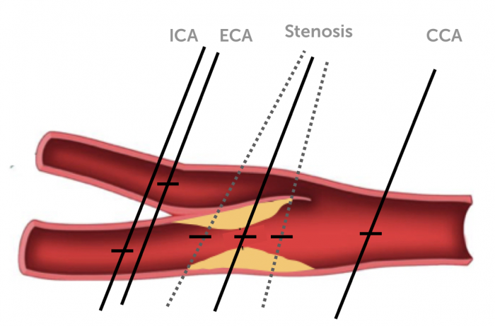 pressure on carotid artery