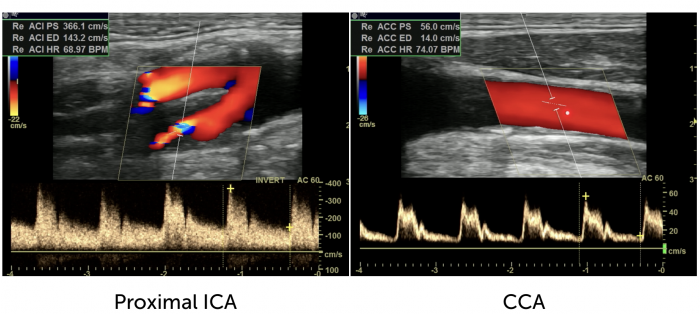 Example Doppler Severe