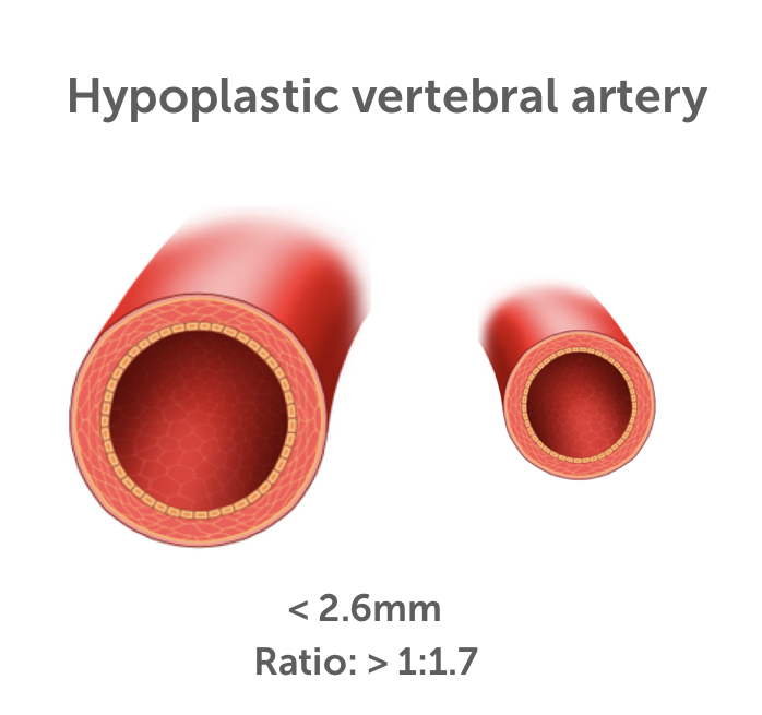 Hypoplastic 