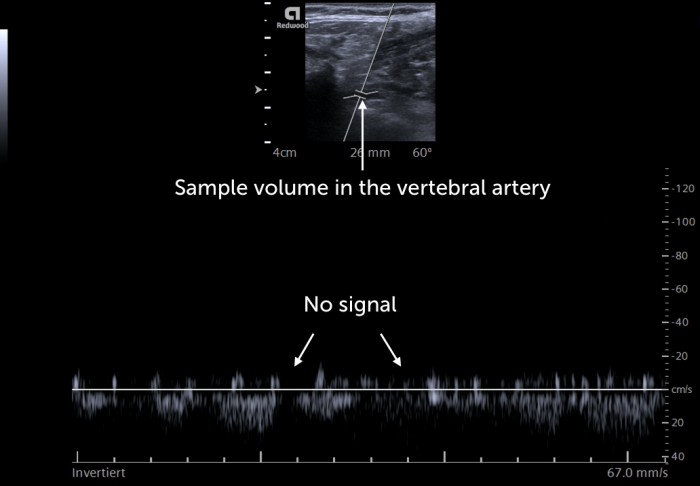 A PW Doppler occlusion