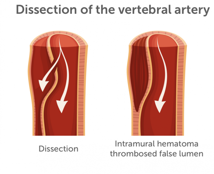 Dissection VA