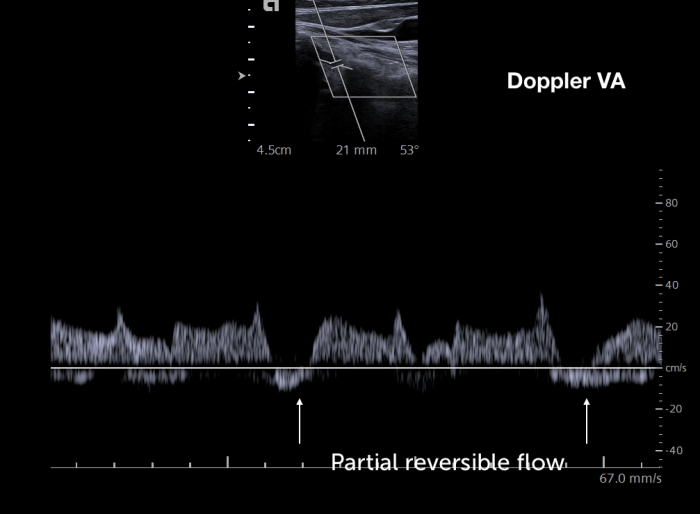 Doppler Stage Subclav steal II