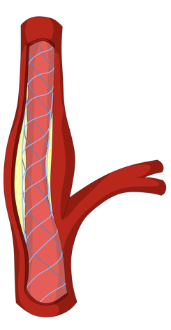 Stenting