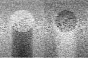 Shadowing (left), Pseudoenhancement (right) Shadowing (left), Pseudoenhancement (right)