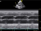 Mode tracing across the aortic sinus and the left atrium Mode tracing across the aortic sinus and the left atrium