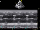 Mode tracing across the aortic sinus and the left atrium