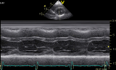 M-mode tracing across the left ventricle M-mode tracing across the left ventricle
