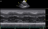 M-mode tracing across the left ventricle