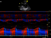 Tissue Doppler Mode Tissue Doppler Mode