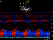 Tissue Doppler Mode