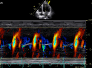 Color Doppler M-mode Color Doppler M-mode