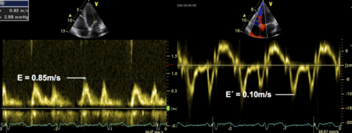 4 4 How To Assess Diastolic Function 123 Sonography