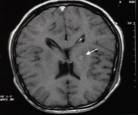 Cranial CT scan with a small unilateral thalamic „hemorrhagic“ lesion.
