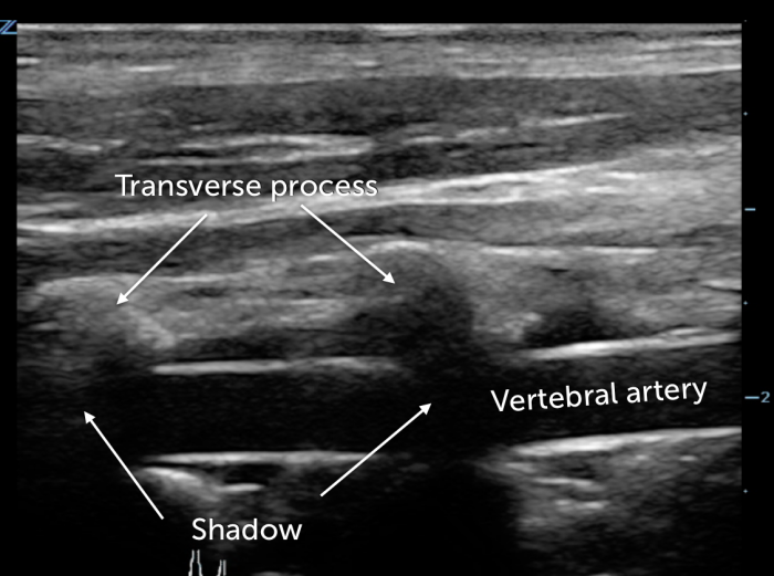 Vertebral artery dissection - Wikipedia