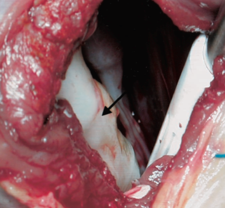 Hydatid cyst seen at surgery