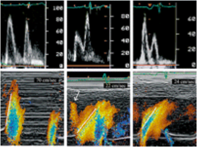 LV diastolic patterns measured by transmitral Doppler of the