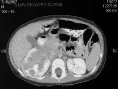 Contrast enhanced axial CT scan (picture 3)