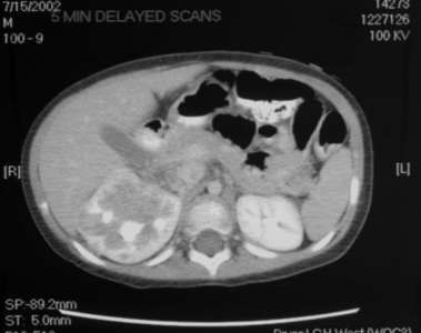 Contrast enhanced axial CT scan