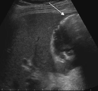 Image of the gallbladder with the patient in slight left decubitus position