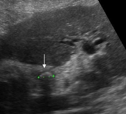 Image of the liver hilum at a 90 degree angle to image 3