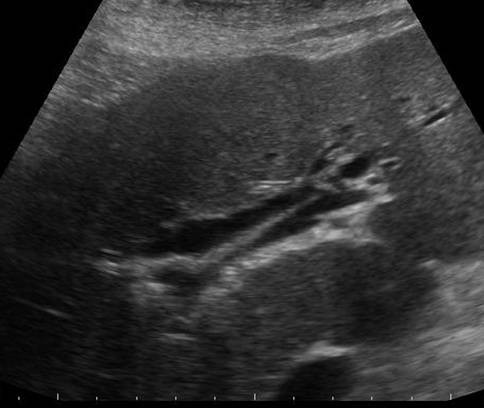 Image of the liver