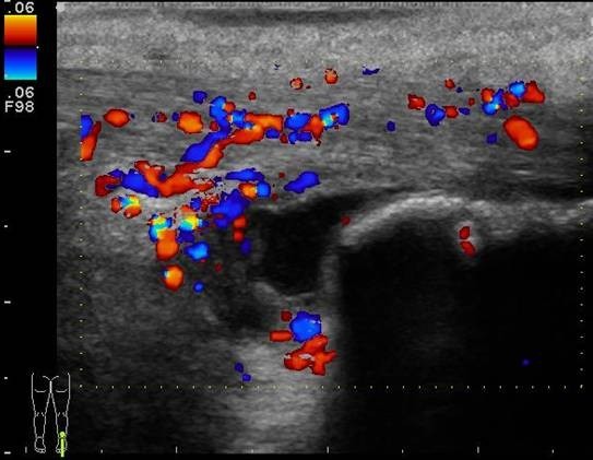 Longitudinal color doppler image of the right distal Achilles tendon