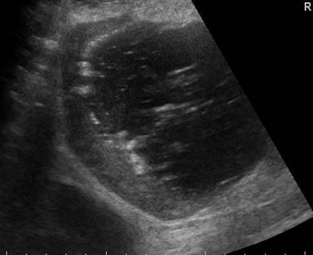 Longitudinal image left upper quadrant in the mid clavicular line