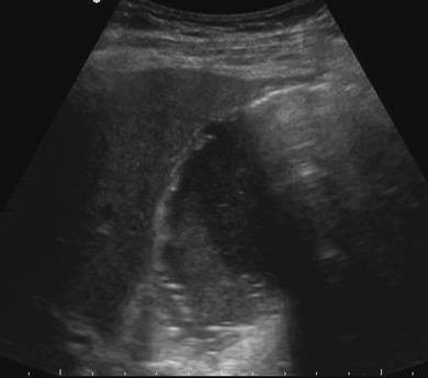 perforated gallbladder ultrasound