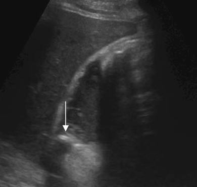 Longitudinal image of the gallbladder