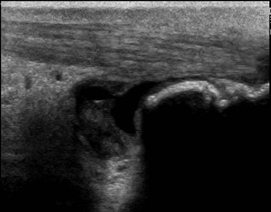 Longitudinal image of the right distal Achilles tendon