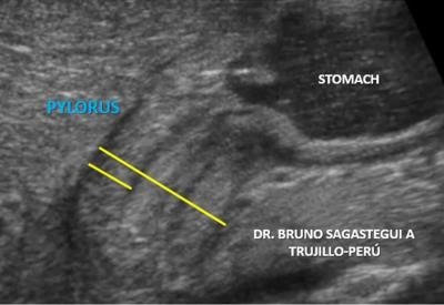 pyloric stenosis upper gi series