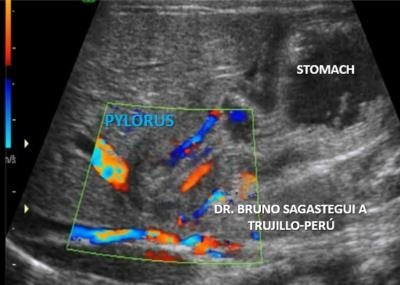 pyloric stenosis shoulder sign